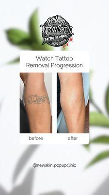 Laser tattoo removal of old tattoo. 12 sessions total.