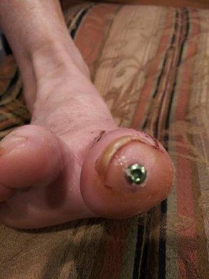 A third toe - screw came out after 2 weeks causing horrible pain.  Dr. Feller yanked out the screw, leaving another deformity!