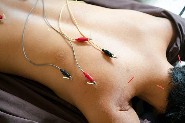 acupuncture with electric stimulation treatment.