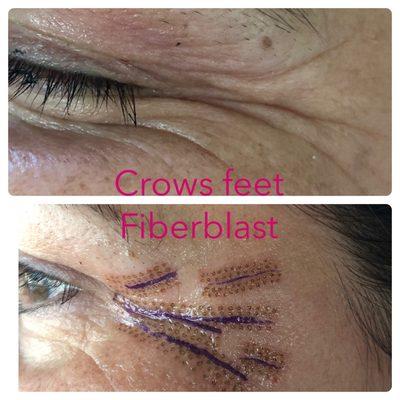 Fiberblast treatments