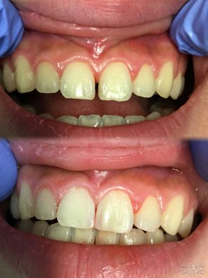 Composite bonding for anterior spacing