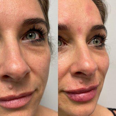 Before & After - Filler