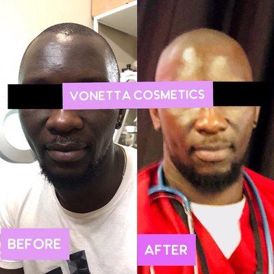 Irritation and discoloration go hand in hand .  After calming irritation, we were able to brighten his skin in less than 1 month:)