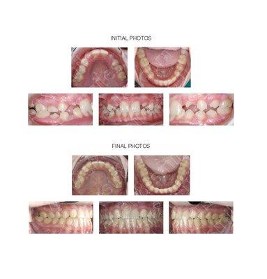 Adolescent with congenitally missing upper lateral incisors.  Spaces completely closed by moving all posterior teeth forward with TAD's.