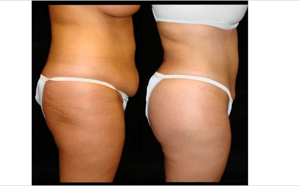 Liposuction