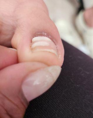 Toenail Ingrown Correction