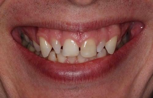 A smile before we made Emax Veneers.