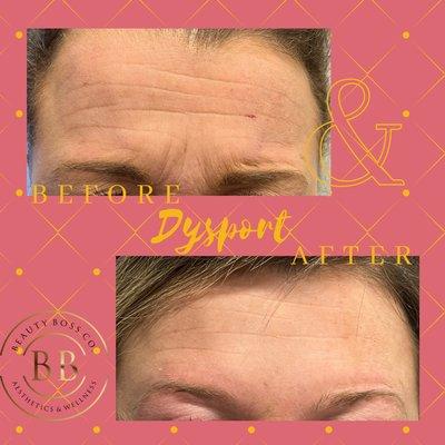 Dysport treatment to glabellar lines and forehead