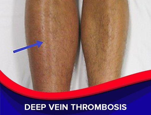 Deep Vein Thrombosis