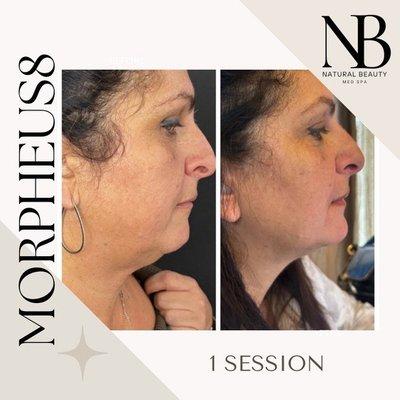 These are the results of just one Morpheus treatment. The tightening of the skin gives the look of a facelift, but there was no surgery!