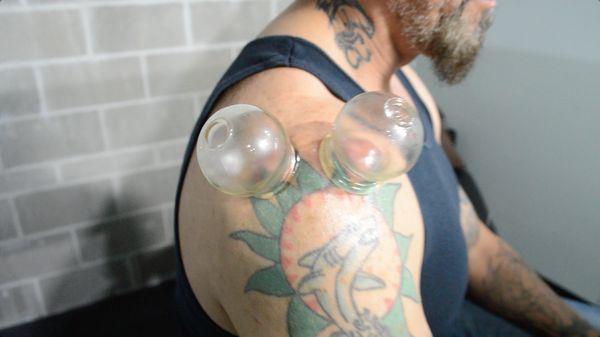 Cupping demonstation