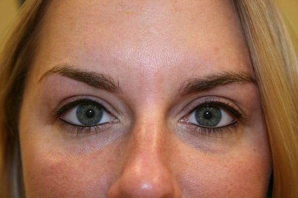 Permanent eyeliner immediately following the procedure.