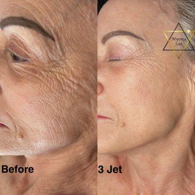 Jet plasma skin tightening, collagen reproduction treatment.  No pain, No downtime.  Done by Jet plasma practitioner Myong Sae