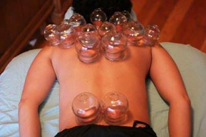 Cupping, Acupuncture in Lake Worth, Florida