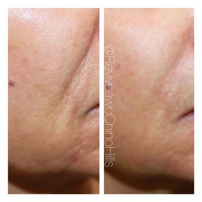 Before and after filler in nasolabial folds, a little in cheek and marionette region.