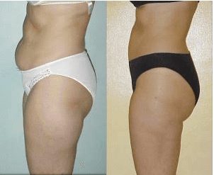 Tickle liposuction before and after