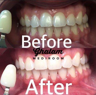 Laser teeth whitening outstanding results.