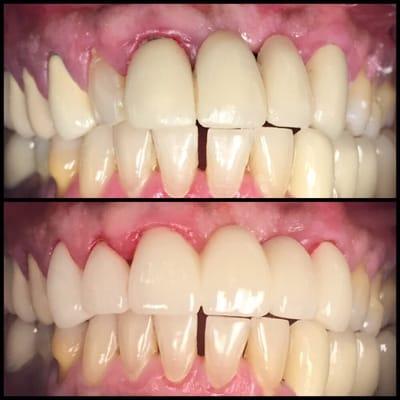 Replacing an old, failing and decaying bridge with a new esthetic full porcelain restoration