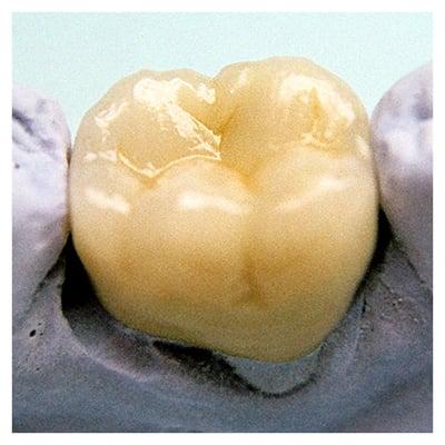 Here is an example of your basic, porcelain fused to metal restoration by DEW Dental Ceramics for tooth #30