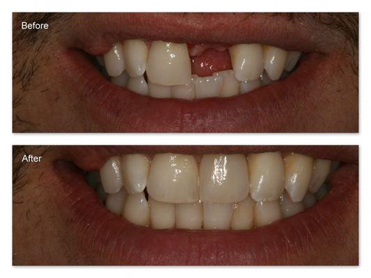 Dr. Hosner placed a dental implant and restored with a porcelain crown.