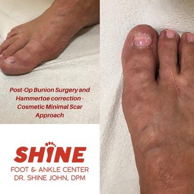 Cosmetic scar closure techniques for Bunion and 2nd toe repair.