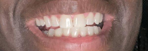 After Laser Teeth Whitening