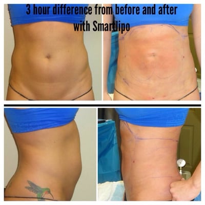 Smartlipo procedure by Dr. Balgobin