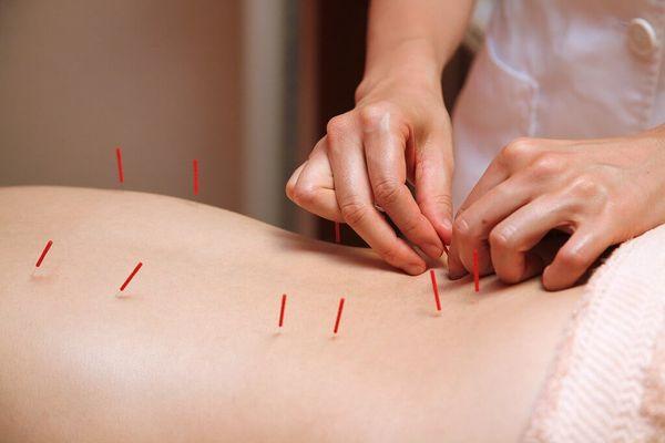 Acupuncture