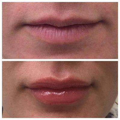 Restylane injections in upper and lower lips. Before (top) and after (bottom).