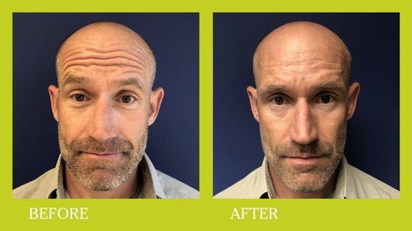 Botox and fillers before and after in a man in his 40's.