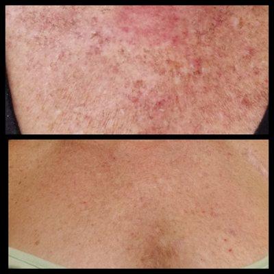 Hyperpigmentation and sun damage before and after results after 1 chemical peel treatment.