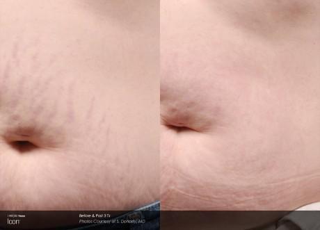 Stretch mark Removal