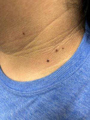 Skin tag treatment with plasma pen