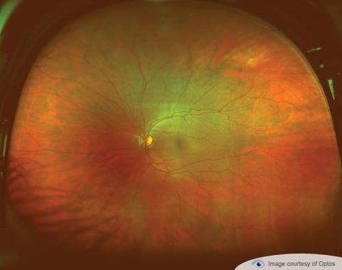 optomap image of a healthy eye