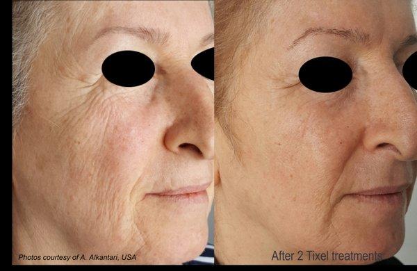 Tixel Full Face Before and After 2 Treatments