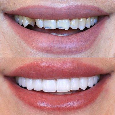 Bridge and veneers!