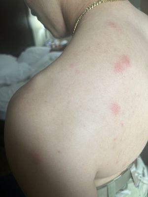 Bed bug bites