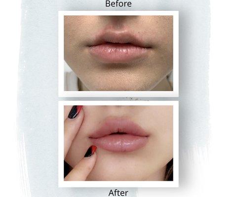 Before and After Lip Augmentation done using Juvederm Ultra Plus XC