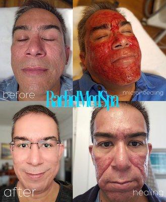 Microneedling treatment before and after just one time