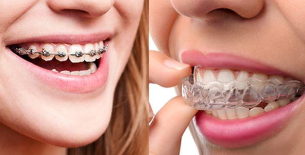 Our Orthodontics service includes correction regular braces and clear removable as well