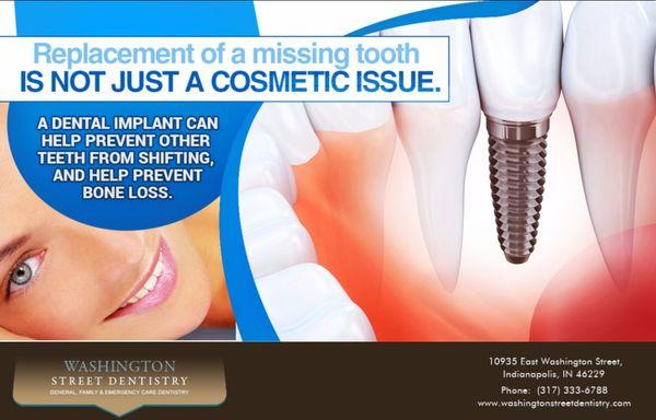 Dental Implants Indianapolis - Tooth Replacement