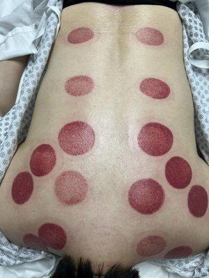 Cupping therapy is believed to stimulate circulation, relieve pain, and promote healing in the affected areas.