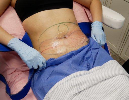 CoolSculpting