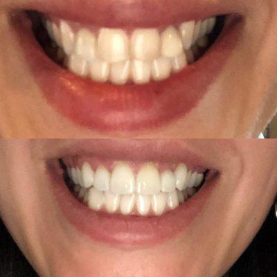 Top shows smile before, and bottom is smile after whitening and cost metic veneers 6 across the top row! Beautiful and natural!