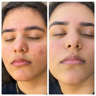 Acne treatment and deep cleaning Facial
PLUS Eyebrows Threading