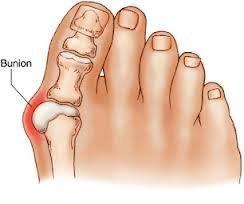 Bunion Example