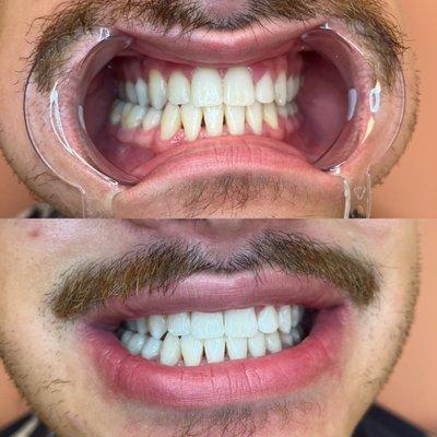 Teeth Whitening