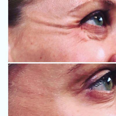 Botox is a quick and easy fix for wrinkles around the eyes