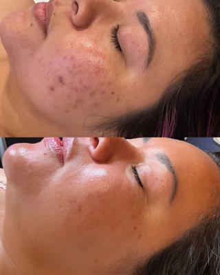 Pigmentation (before and after)