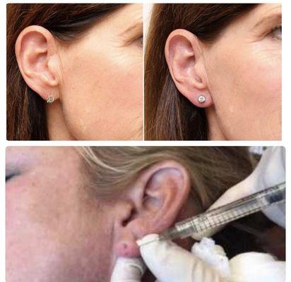 Are your earring holes drooping from overweight jewelry? We got the solution for you!